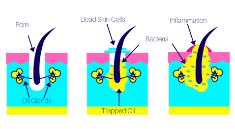 acne development