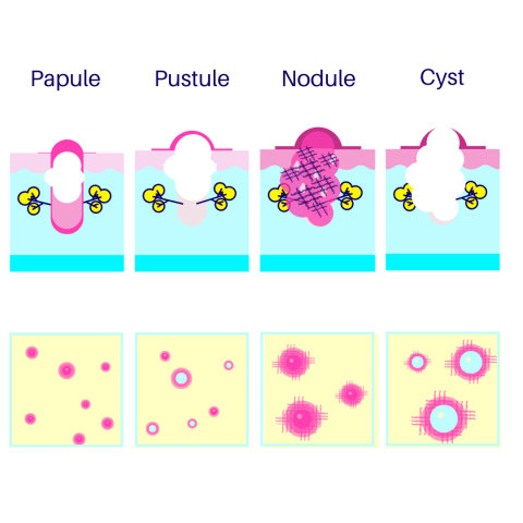 types of acne