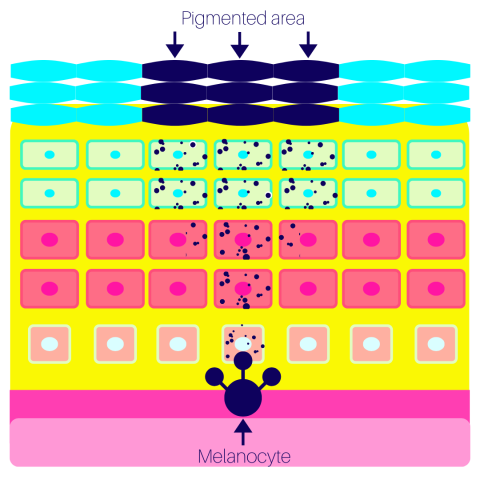 Hyperpigmentation formation