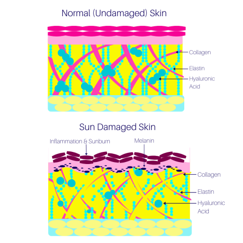 Sundamage effect on skin