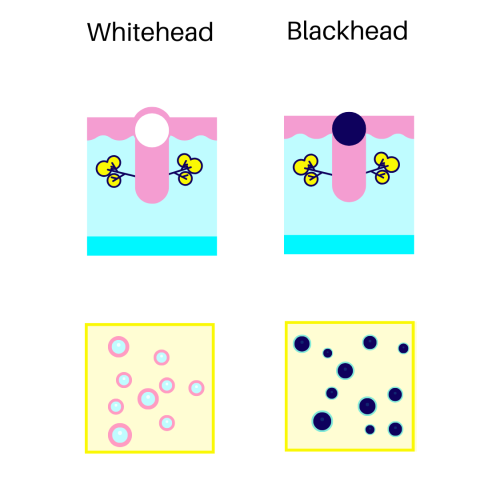 white head vs black head